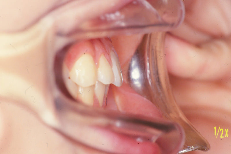 出っ歯（上顎前突）症例①After