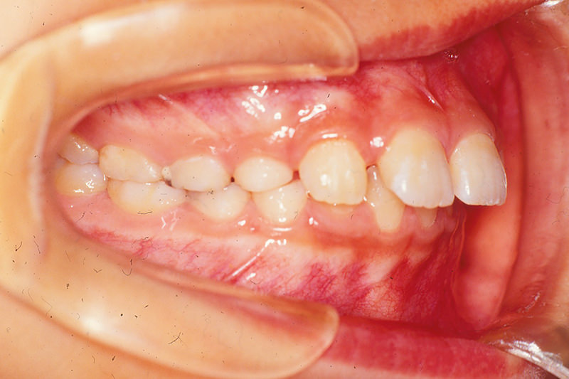 出っ歯（上顎前突）症例②Before