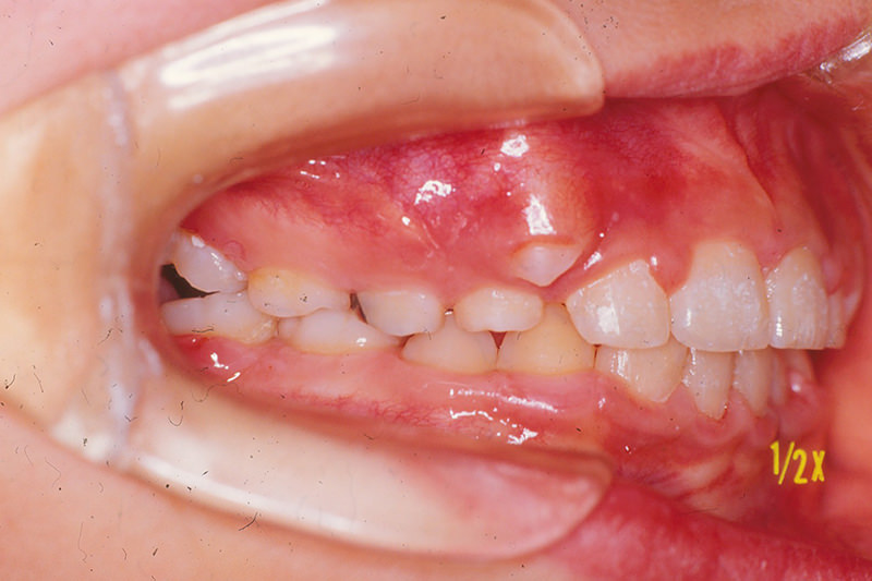 出っ歯（上顎前突）症例②治療中