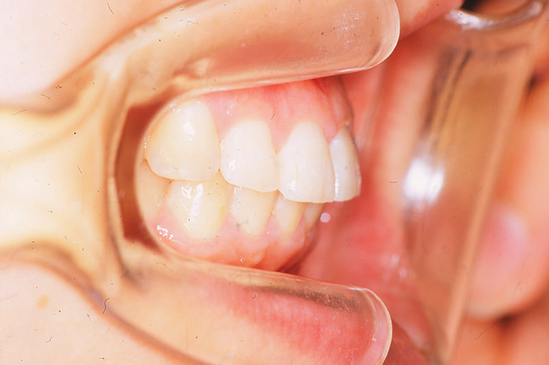 出っ歯（上顎前突）症例②After