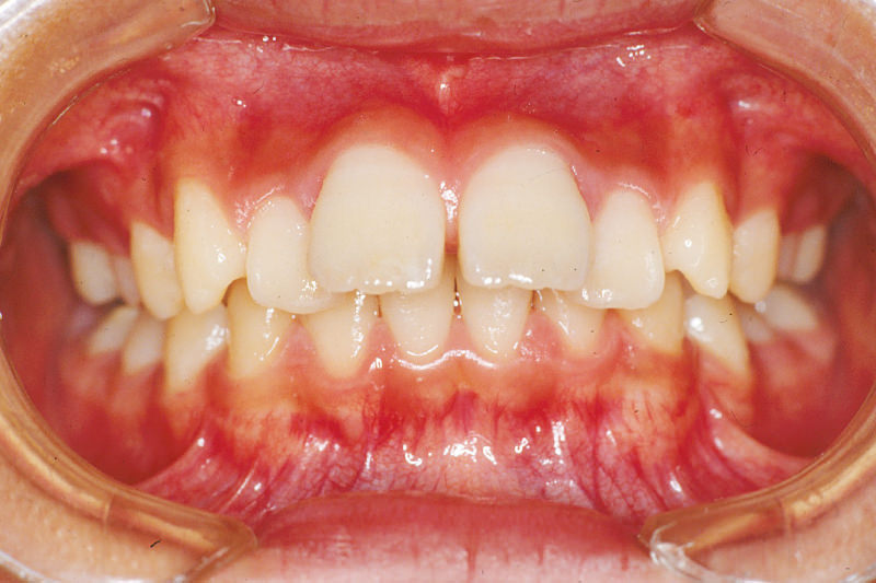出っ歯（上顎前突）症例③Before