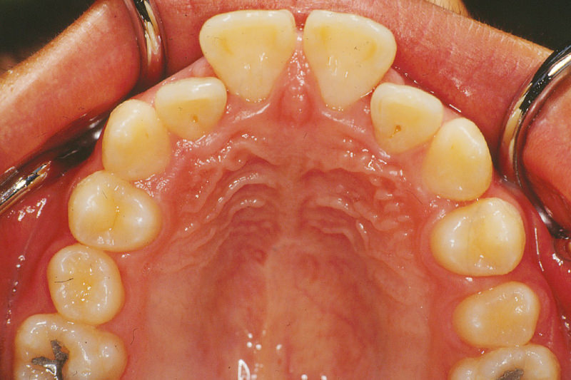 出っ歯（上顎前突）症例③Before