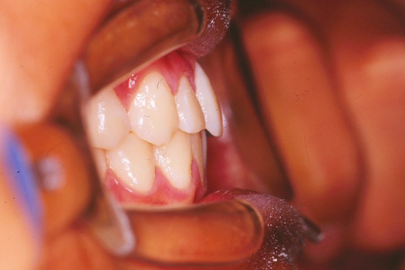 出っ歯（上顎前突）症例③After