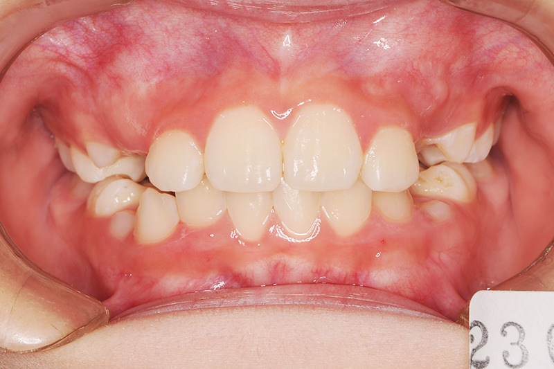 ガタガタの歯並び（叢生）症例①After