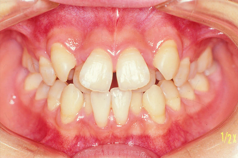 ガタガタの歯並び（叢生）症例②Before