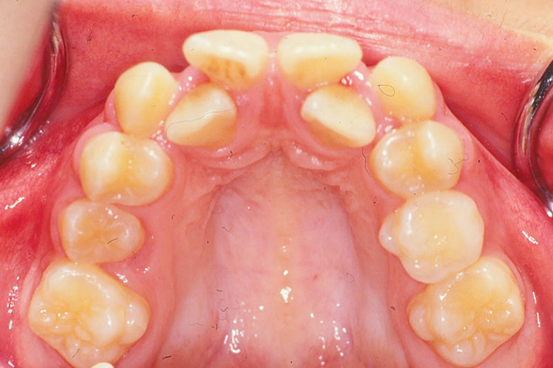 ガタガタの歯並び（叢生）症例②Before