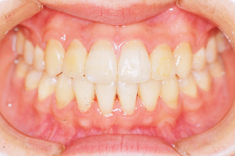 ガタガタの歯並び（叢生）症例②After