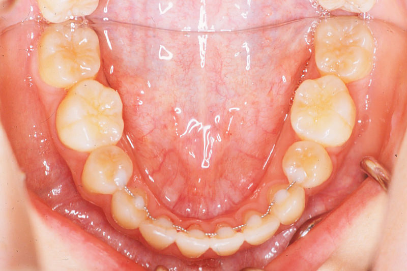 ガタガタの歯並び（叢生）症例②After