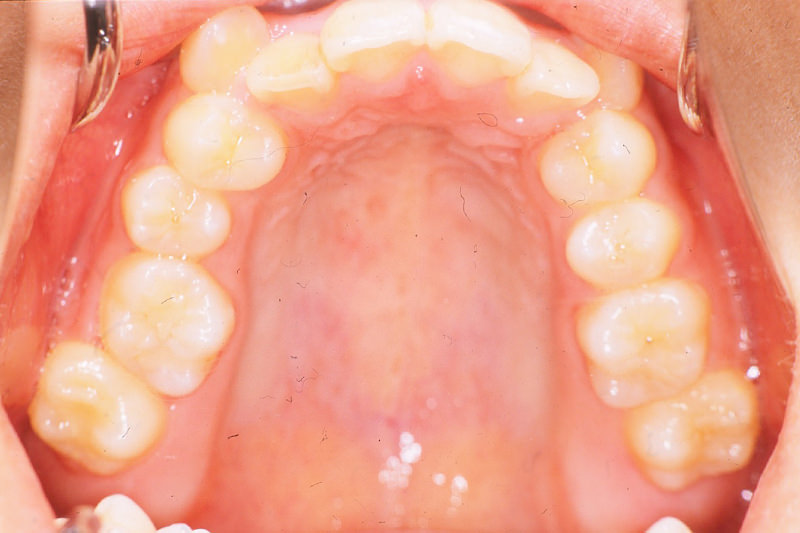 八重歯症例①Before