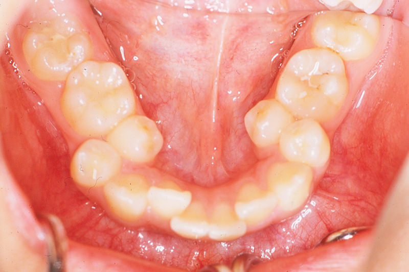 八重歯症例①Before