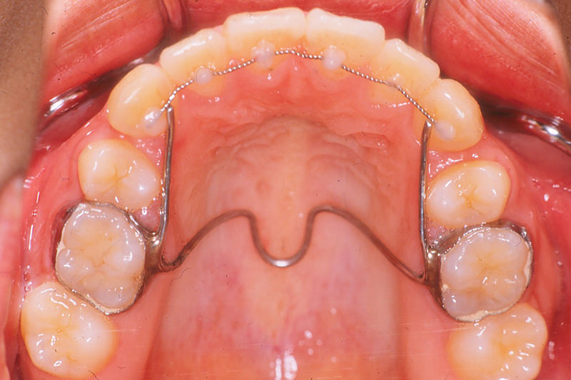八重歯症例①After