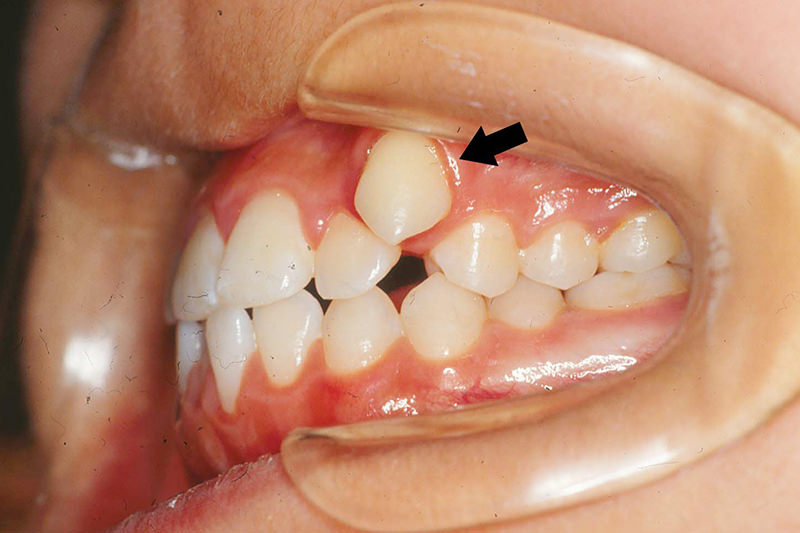 八重歯症例②Before