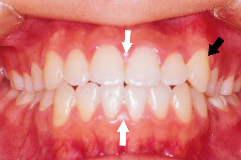八重歯症例②After