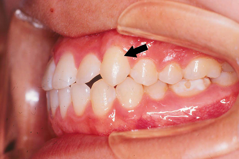 八重歯症例②After